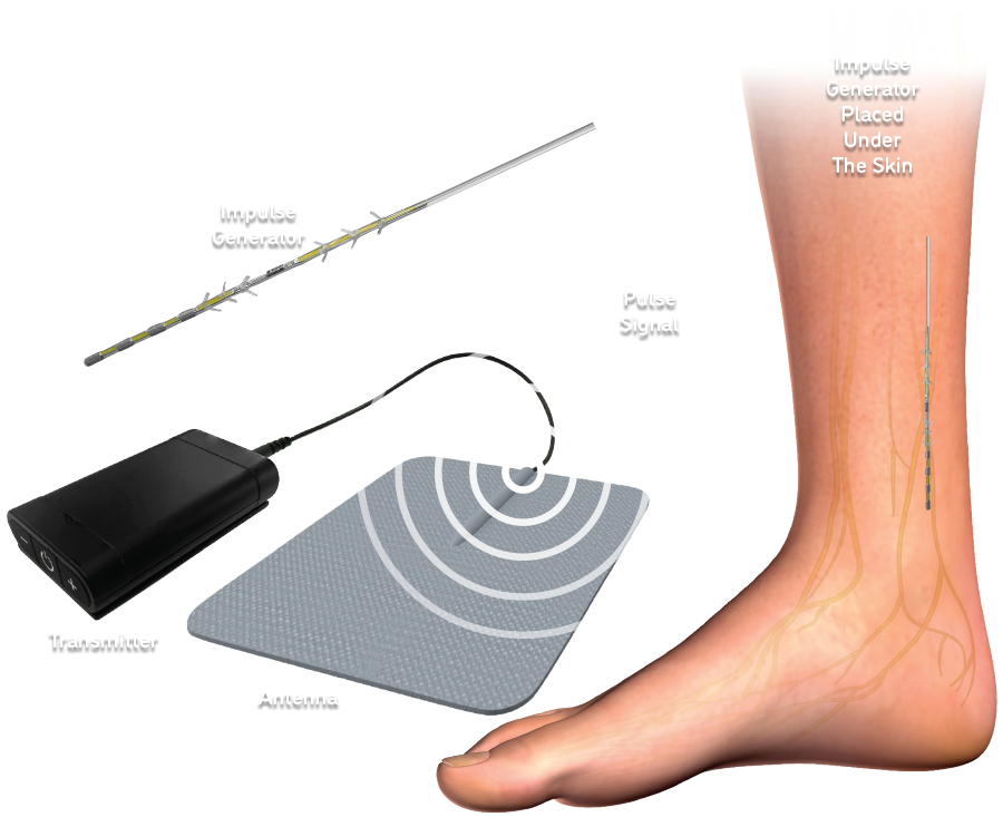 nrvpulse peripheral nerve stimulation powered by ministim